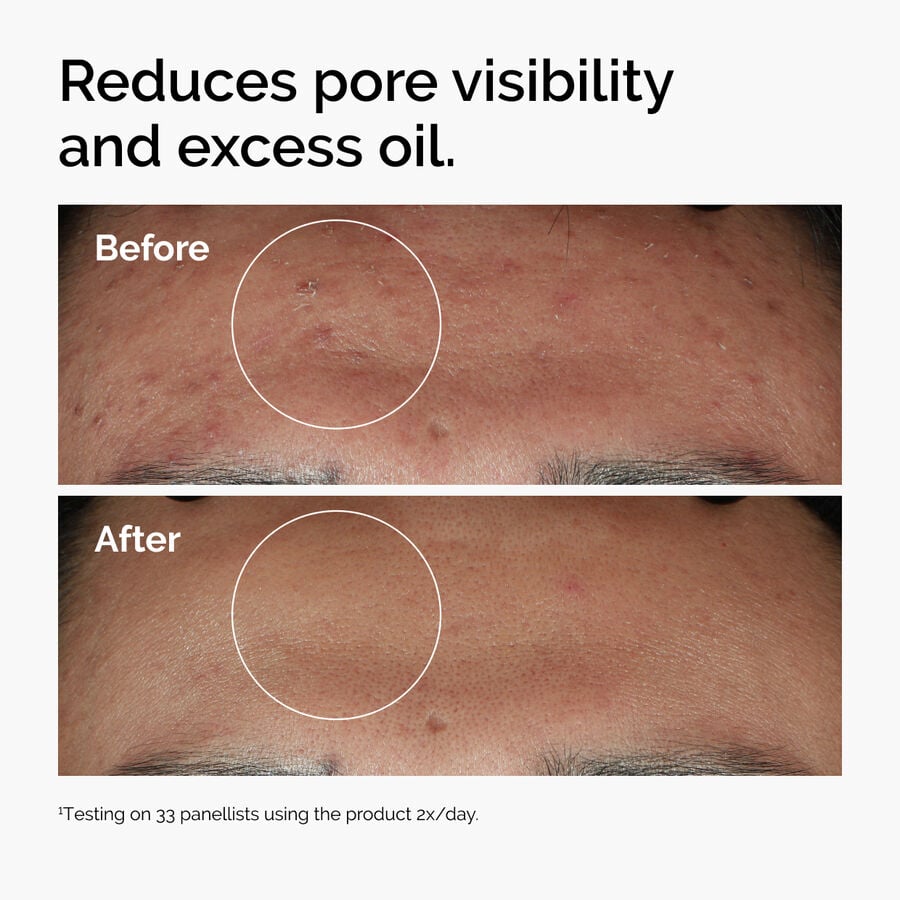 niacinamide-10-zinc-1-s3 ord-niacinamide-zinc-blemish-serum-before-after-pores.jpg