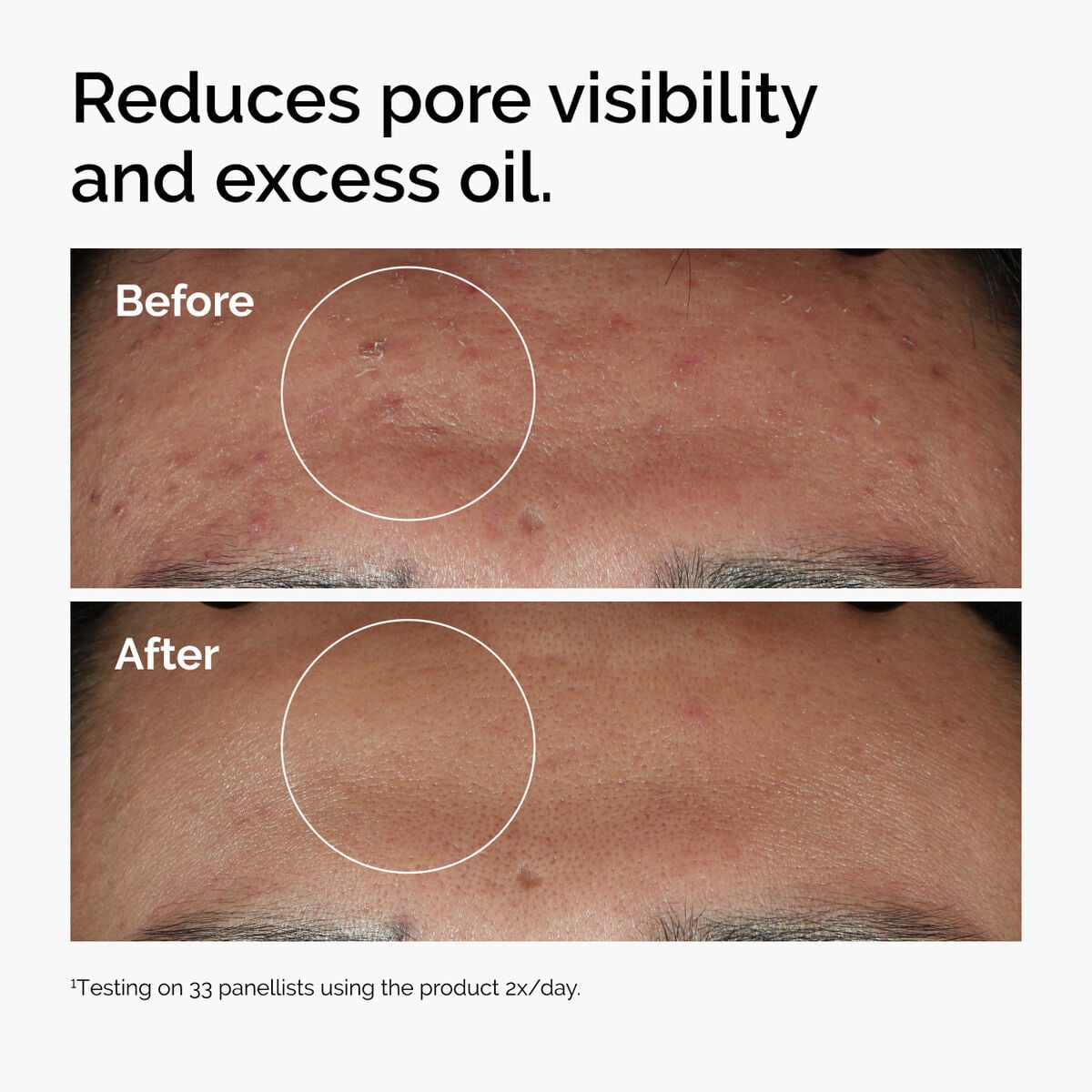 niacinamide-10-zinc-1-s3 ord-niacinamide-zinc-blemish-serum-before-after-pores.jpg