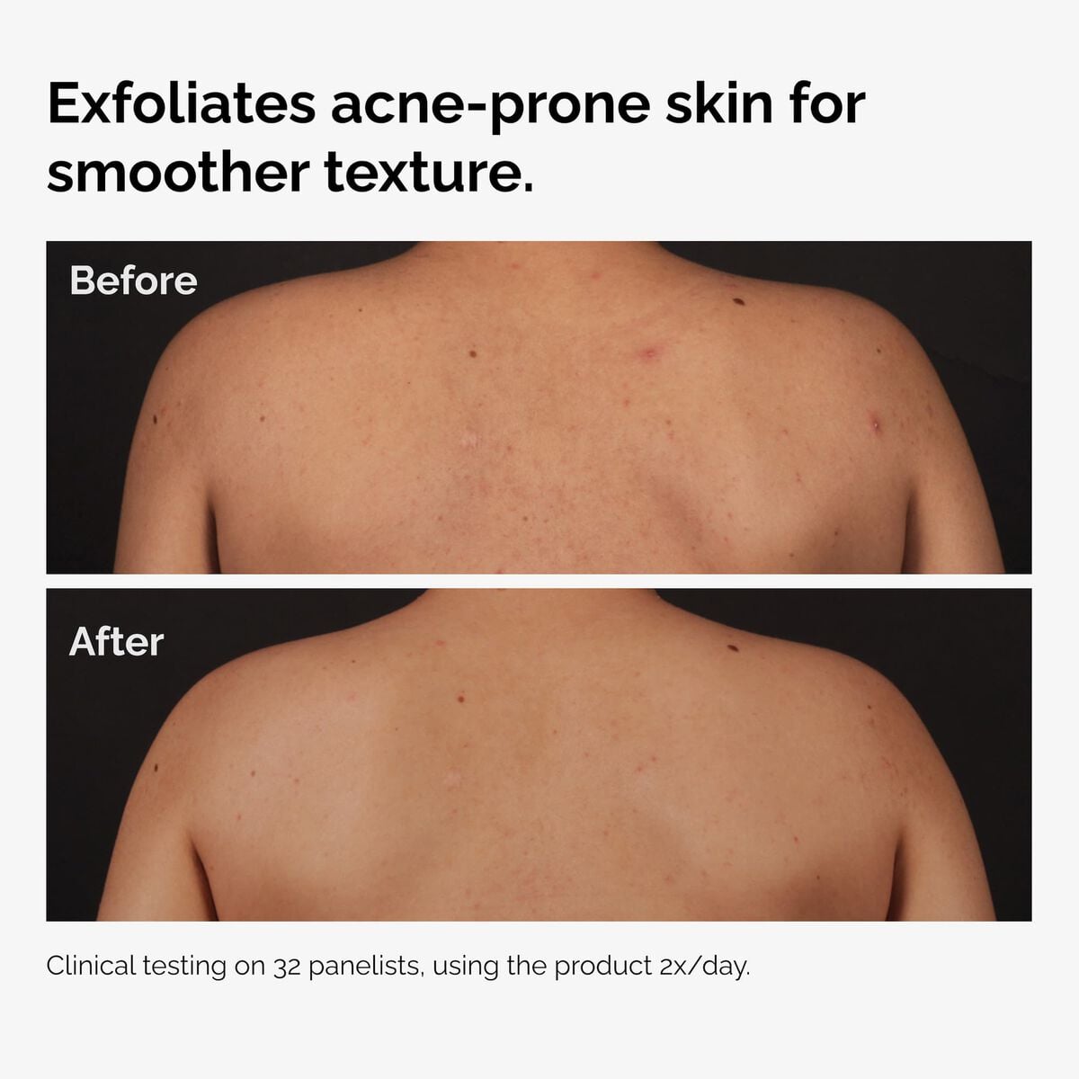 salicylic-acid-0-5-body-serum-u6 ord-salicylic-acid-body-serum-before-after-graphic-NA.jpg
