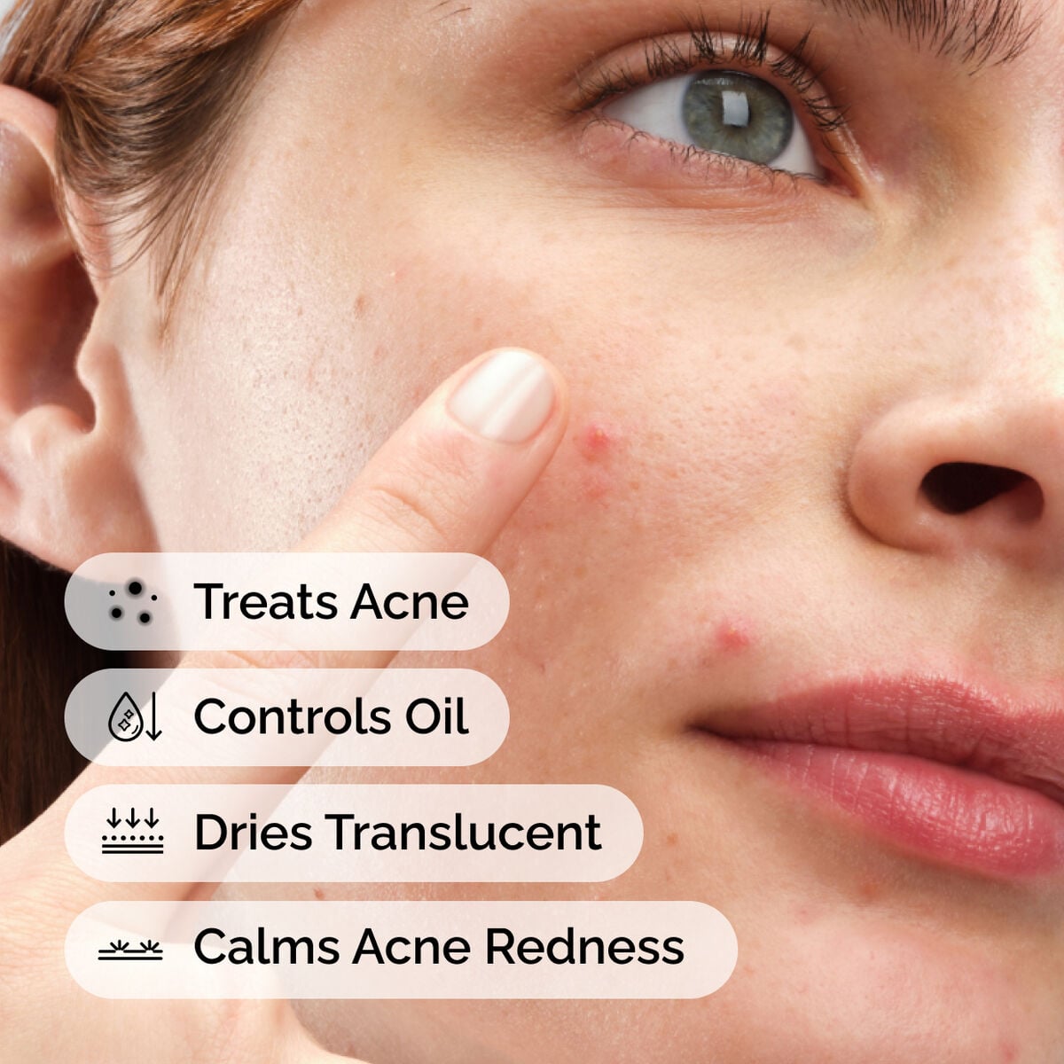 sulfur-10-powder-to-cream-concentrate-a0 ord-sulfur-10pct-powder-to-cream-concentrate-model-application-with-benefits-acne.jpg
